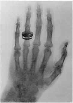 x-ray photo of a left hand